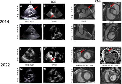 Recurrence of an undifferentiated pleomorphic pulmonary artery sarcoma 8 years after initial presentation: a case report